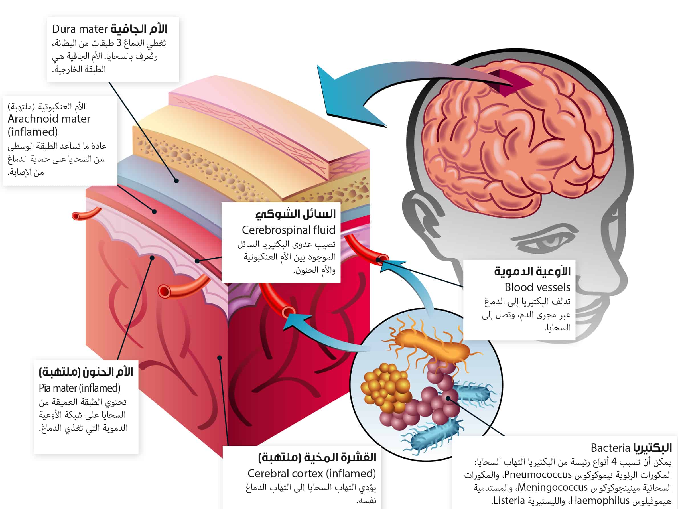 التهاب الأغشية السحائية
