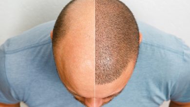 زراعة الشعر